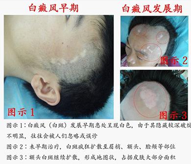 男性什么会患白癜风